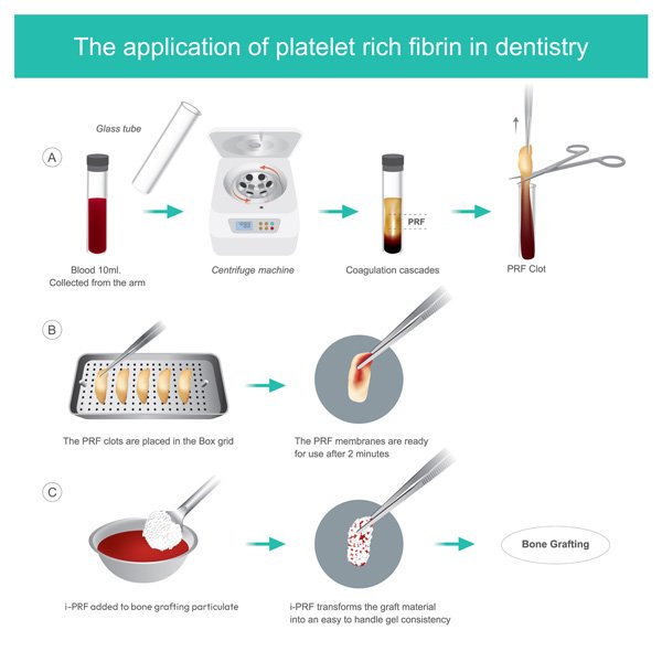 application-of-prf-in-dentistry-3